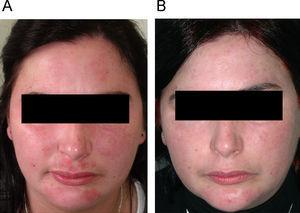 A) Placas eritematodescamativas faciales. Pretratamiento. B) Buena respuesta tras el tratamiento.