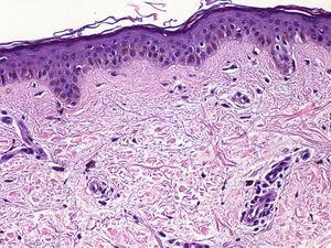 En el estudio histopatológico se observa una hiperpigmentación de la capa basal de la epidermis y presencia de numerosos melanófagos dérmicos (hematoxilina-eosina × 100).