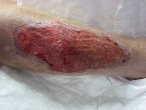 Úlcera en la pierna contralateral tras drenaje y posterior tratamiento de cierre asistido con vacío.