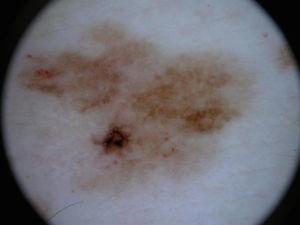 Imagen dermatoscópica del primer melanoma.