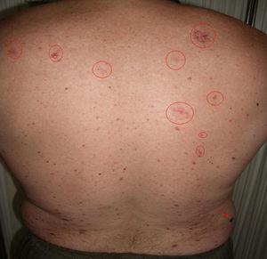 Múltiples carcinomas basocelulares en la espalda (círculos). Melanoma en el flanco derecho (flecha).