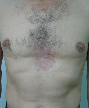 Placa eritematosa reticulada en la región preesternal antes del tratamiento.