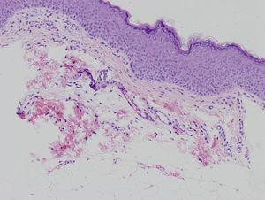 Biopsia cutánea de una lesión atrófica que muestra atrofia de la dermis y presencia de tejido adiposo en la dermis, hematoxilina-eosina×20.