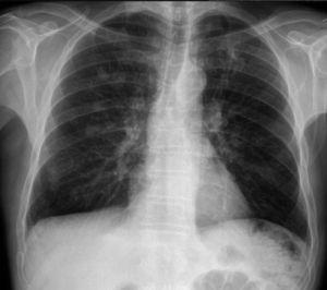 Radiografía de tórax donde se observan tractos fibrocicatriciales en el lóbulo superior izquierdo y granuloma no calcificado en el lóbulo superior derecho, que denotan infección pasada por M.tuberculosis.