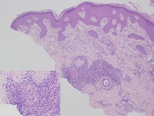 Hiperplasia epidérmica y estructuras granulomatosas en la dermis (hematoxilina-eosina [H-E] x4). Detalle a 20×: granulomas formados por células epitelioides, linfocitos y células gigantes sin observarse necrosis caseosa.