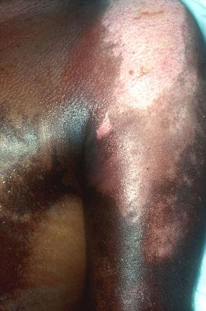 Hiperpigmentación en piel en un afectado por iperita.