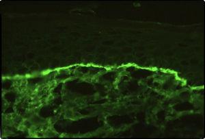 Inmunofluorescencia positiva con depósitos lineales de IgG en la membrana basal.