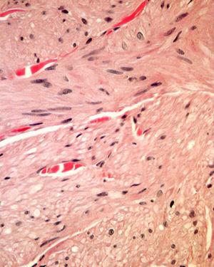Haces formados por células fusiformes de citoplasma eosinófilo y núcleos alargados de bordes romos. Hematoxilina-eosina, ×20.