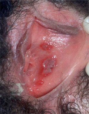Lesiones erosivas rodeadas de un halo eritematoso. Las manifestaciones clínicas de las recidivas suelen ser menos intensas que las que aparecen en el curso de una primoinfección.