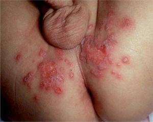 Primoinfección por herpes genital en niños. En estos casos es necesario descartar abusos sexuales.