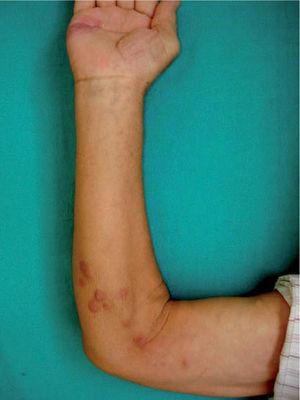 Lesiones nodulares subcutáneas eritematosas siguiendo un patrón esporotricoide a lo largo del antebrazo.
