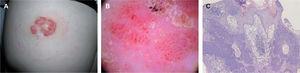 A. Placa eritematosa multifocal en la nalga. B. Detalle dermatoscópico con un patrón vascular polimorfo compuesto por vasos lineales, vasos glomerulares y vasos en horquilla. C. Imagen histológica (hematoxilina-eosina, ×20) del tumor constituido por cordones de células basaloides sin atipia ni mitosis localizados en la epidermis y la dermis superior.