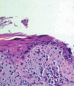 epidermale atipia citologica e infiammatoria infiltrata nel derma (ematossilina-eosina, x400).
