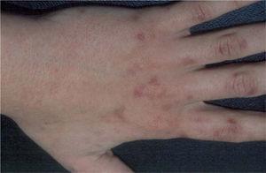Lesiones hiperpigmentadas residuales en el dorso de las manos.