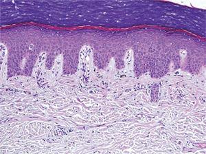 Epidermis respetada, leve dilatación del plexo vascular superficial e incontinencia pigmentaria (tinción de hematoxilina-eosina, ×100).