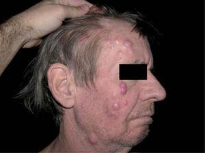 Lesiones nodulares múltiples en la región facial.