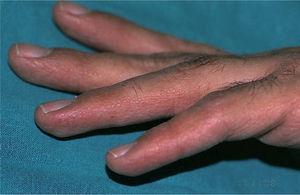 Lesiones papulosas en los bordes laterales de los dedos.