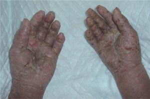 Lesiones en las palmas de las manos en las que se aprecia gran cantidad de pústulas con formación de lagos pustulosos.