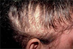 Pelo ralo en las regiones temporales y pústulas foliculares aisladas en las zonas de peinado con coletas en ambos lados de la cabeza.