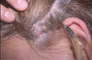 Pápulo-pústulas foliculares en las zonas de máxima tracción de una extensión capilar. El pegamento de la extensión puede apreciarse en el conglomerado de pelo situado en la trenza sobre la oreja.