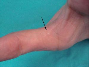 Pápula fibrosa del color de la piel, de 3mm, en la cara palmar del pulgar izquierdo.