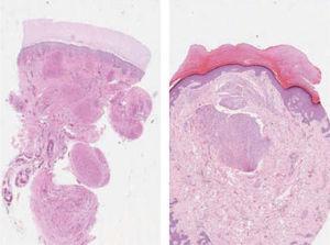 Panorámica de ambas lesiones: nódulos más celulares en la dermis (hematoxilina-eosina, x2).