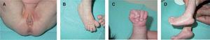 Múltiples rasgos malformativos típicos de esta entidad. A. Hipoplasia de labios mayores con clítoris prominente. B. Sindactilia del segundo y tercer dedo del pie. C. Mano trisómica. D. Pie en mecedora.