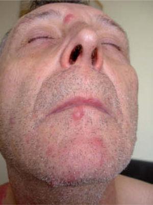 Lesiones nodulares asintomáticas en la cara.