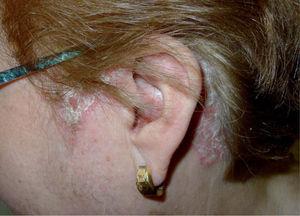 Paciente afecta de psoriasis del cuero cabelludo, en la que destaca la afectación más allá de la línea de implantación del cabello en la región fronto-temporal y retroauricular, en forma de placas visibles, eritemato-descamativas, blanco-plateadas, individuales y bien delimitadas.