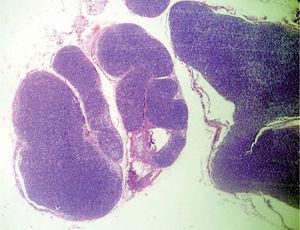 Histología (H/E vista panorámica). Neoformación separada de la epidermis por una banda de colágeno normal.