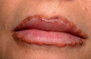 Reacción inflamatoria granulomatosa tras micropigmentación del reborde labial.