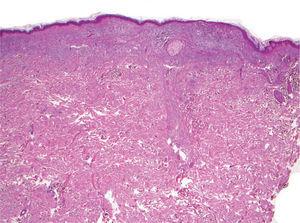 Imagen panorámica de un melanoma con regresión temprana (hematoxilina-eosina, ×40).