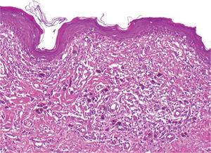 Detalle de la figura 3, donde se aprecian abundantes melanófagos con fibrosis y neovascularización. El infiltrado linfocitario es escaso y no quedan restos del melanoma (hematoxilina-eosina, ×200).