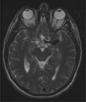 Alopecia Rectangular Transitoria Tras Embolizacion De Aneurisma A Proposito De Un Caso Actas Dermo Sifiliograficas