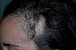 Paciente con una placa de alopecia en la región temporal izquierda.