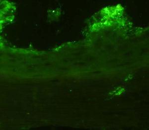 Estudio de inmunofluorescencia negativo: no se observan depósitos de IgG epidérmicos.