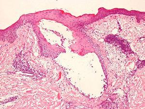 Muestra de piel del área no irradiada en la que se observa un infiltrado neutrofílico que rodea el folículo piloso. Hematoxilina-eosina, ×40.