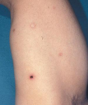 Lesión papulocostrosa con cicatrices varioliformes.