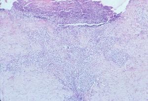 Papulosis linfomatoide tipo A. Infiltrado en cuña con base dirigida a la epidermis (hematoxilina-eosina×100).