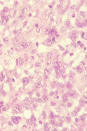 Detalle de infiltrado de papulosis linfomatoide tipo C, indistinguible del que aparece en un linfoma anaplásico de células grandes CD30+ (hematoxilina-eosina×400).