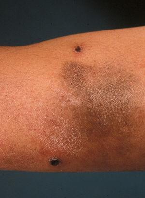 Lesiones papulocostrosas de papulosis linfomatoide con placa de micosis fungoide.