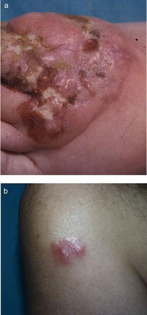 Dos lesiones tumorales de varios centrímetros de diámetro, infiltradas, en el dorso de pie (a) y en la región deltoidea (b). Estudio histológico e inmunohistoquímico compatible con linfoma anaplásico de células grandes CD30+.