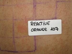 Positividad de pruebas epicutáneas (96h) al tinte Reactive Orange 107.