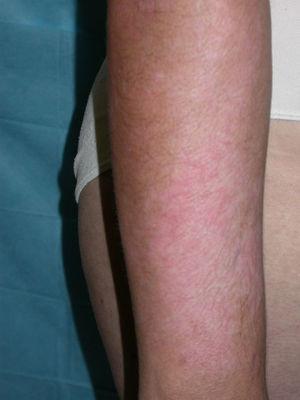 Imagen de las lesiones iniciales en los brazos, donde se aprecian pápulas eritematosas sobre una piel hipopigmentada.
