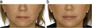 Paciente tratada con ácido hialurónico en los labios antes (a) y después (b) del tratamiento (foto cedida por Q-Med, España, S.L.).