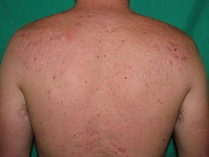 Lesiones cicatriciales residuales en la espalda una vez controlado el proceso con el tratamiento.