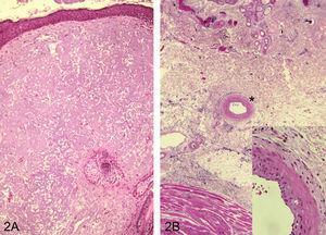 Elastosis solar que afecta toda la dermis en la zona adyacente a un carcinoma espinocelular. H/E ×100 (A). Elastosis solar que se extiende hasta dermis reticular profunda e incluso afecta la pared de una arteria (*), H/E x200 (B) (detalle en recuadro inferior, H/E ×400).