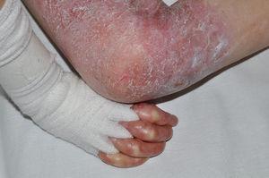 Separación proximal de los dedos de las manos por medio de vendas de algodón para prevenir la fusión proximal de los dedos (webbing).