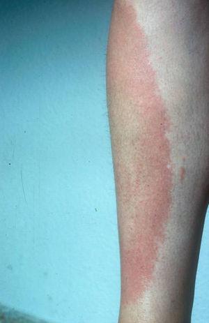 Eritema crónico migrans en la pierna, días después de la picadura de una garrapata.