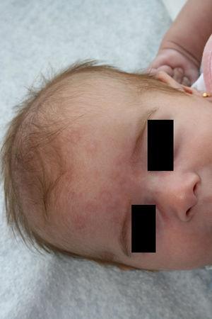 Lupus neonatal. Lesiones anulares características en la frente y en el cuero cabelludo